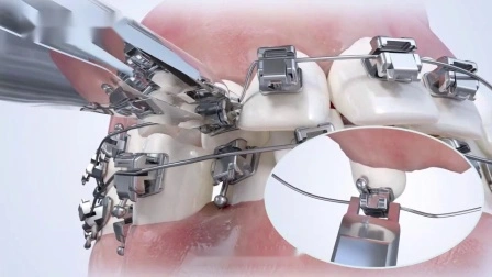 Kieferorthopädische Produkte stellen kieferorthopädische passive selbstligierende Zahnspangen her